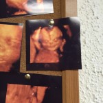 ultrazvuk-bebe (11)