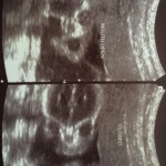 ultrazvuk-bebe (14)