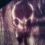 ultrazvuk-bebe (15)
