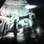 ultrazvuk-bebe (18)