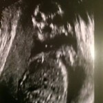ultrazvuk-bebe (2)