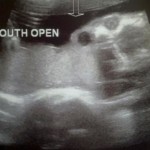 ultrazvuk-bebe (21)