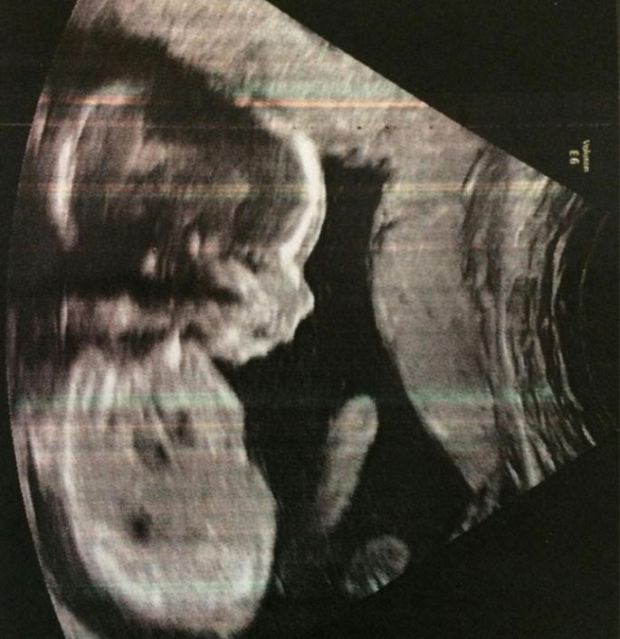 beba-ultrazvuk (1)